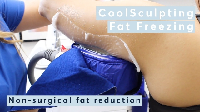Frosting Away Fat: Unveiling the Secrets of Cool Sculpting