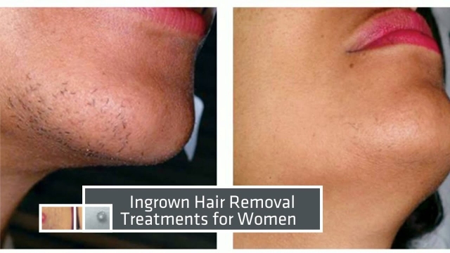 Unveiling the Magic of Laser Hair Removal