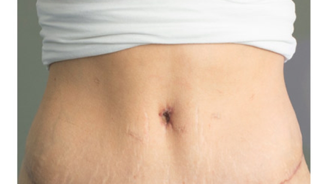 Slimming Secrets: Unveiling the Magic of Tummy Tucks