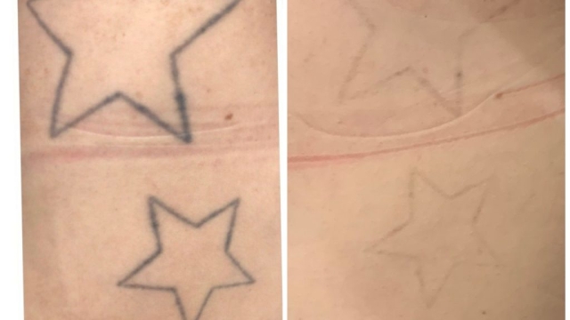 Laser Tattoo Removal Cost – Should It Be Worth Doing It?