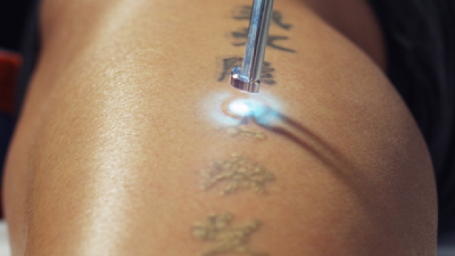 Safe Tattoo Removal For Women