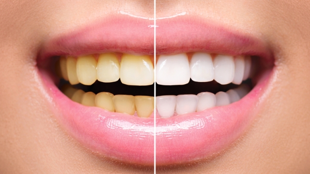 Brighten Your Smile with Crest Whitening Strips: Unveiling the Secrets to a Dazzling Smile