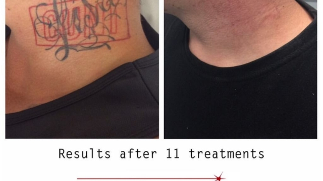 Laser Tattoo Removal – How Effective Is It?