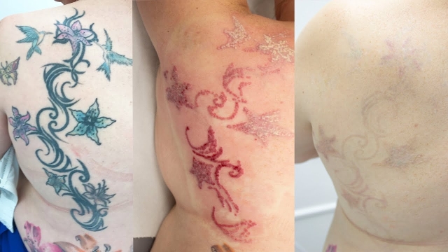 Laser Tattoo Removal Costs – Significant Cost Of Tattoo Regret